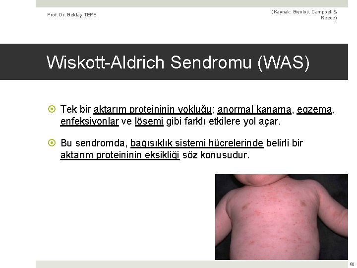 Prof. Dr. Bektaş TEPE (Kaynak: Biyoloji, Campbell & Reece) Wiskott-Aldrich Sendromu (WAS) Tek bir