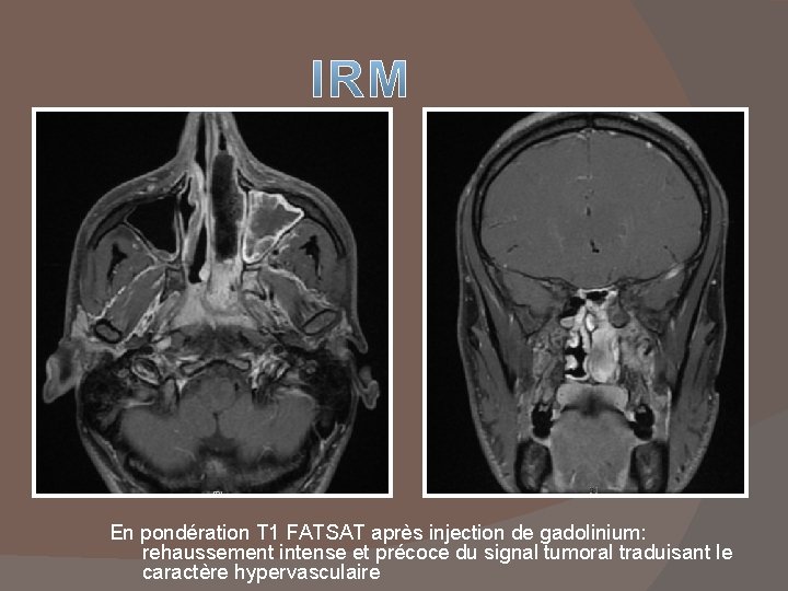 En pondération T 1 FATSAT après injection de gadolinium: rehaussement intense et précoce du