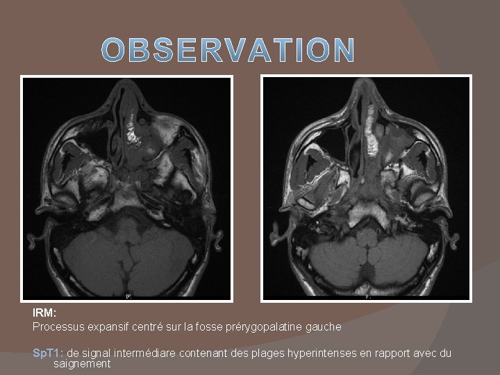 IRM: Processus expansif centré sur la fosse prérygopalatine gauche Sp. T 1: de signal