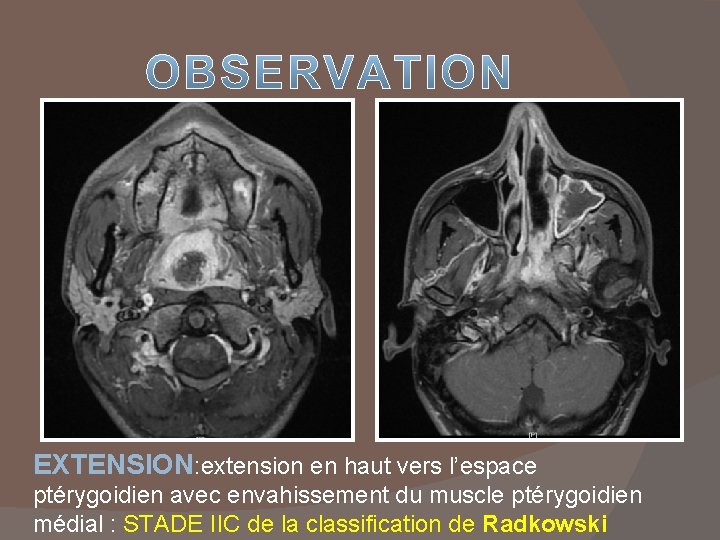 EXTENSION: extension en haut vers l’espace ptérygoidien avec envahissement du muscle ptérygoidien médial :