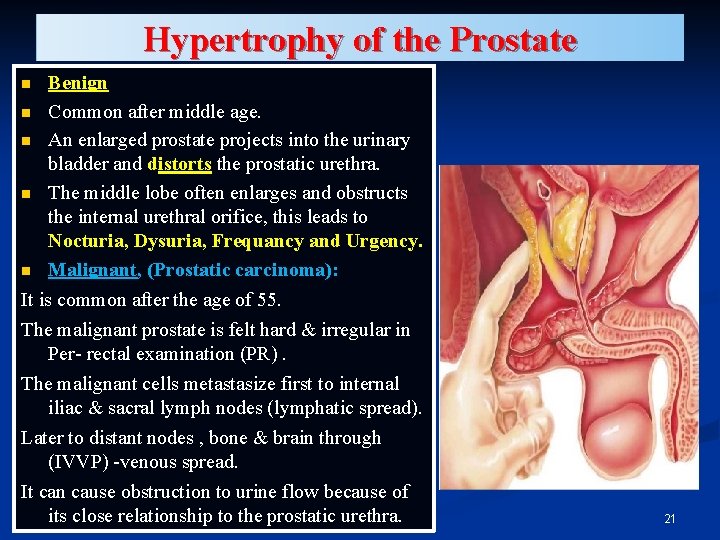 Hypertrophy of the Prostate Benign n Common after middle age. n An enlarged prostate Hypertrophy of the Prostate Benign n Common after middle age. n An enlarged prostate