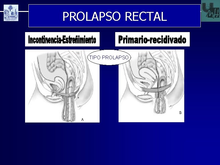 PROLAPSO RECTAL TIPO PROLAPSO 