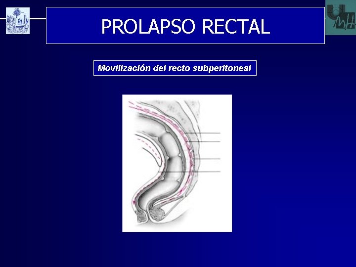 PROLAPSO RECTAL Movilización del recto subperitoneal 