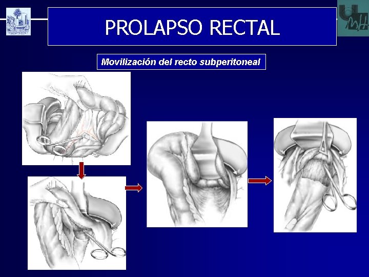 PROLAPSO RECTAL Movilización del recto subperitoneal 