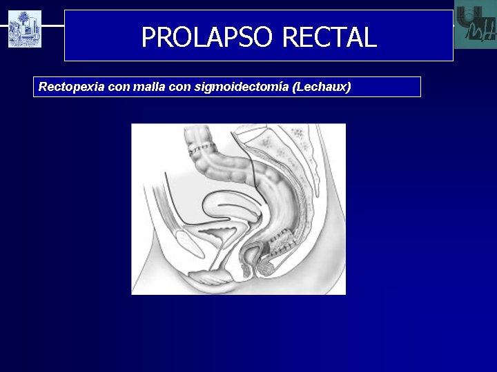 PROLAPSO RECTAL Rectopexia con malla con sigmoidectomía (Lechaux) 