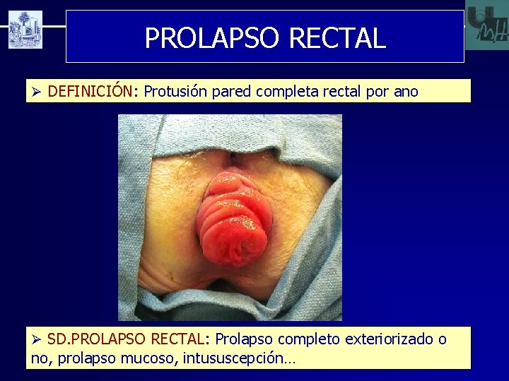 PROLAPSO RECTAL Ø DEFINICIÓN: Protusión pared completa rectal por ano Ø SD. PROLAPSO RECTAL: