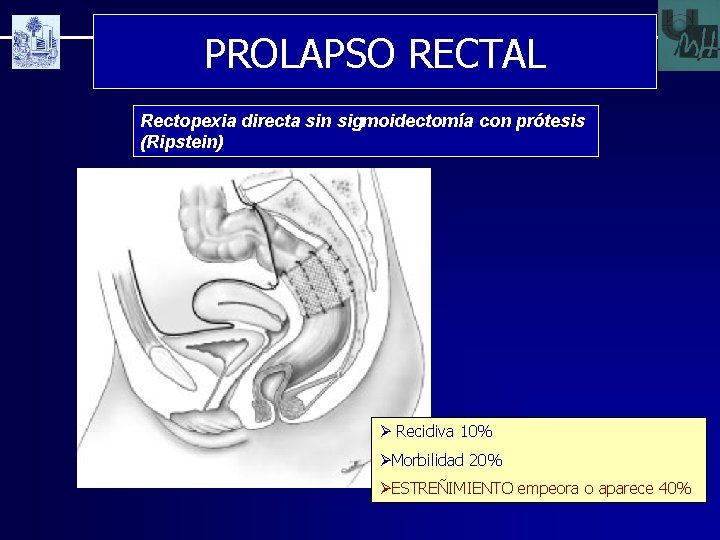 PROLAPSO RECTAL Rectopexia directa sin sigmoidectomía con prótesis (Ripstein) Ø Recidiva 10% ØMorbilidad 20%