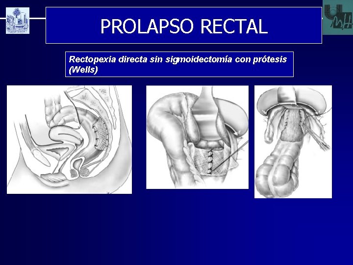 PROLAPSO RECTAL Rectopexia directa sin sigmoidectomía con prótesis (Wells) 