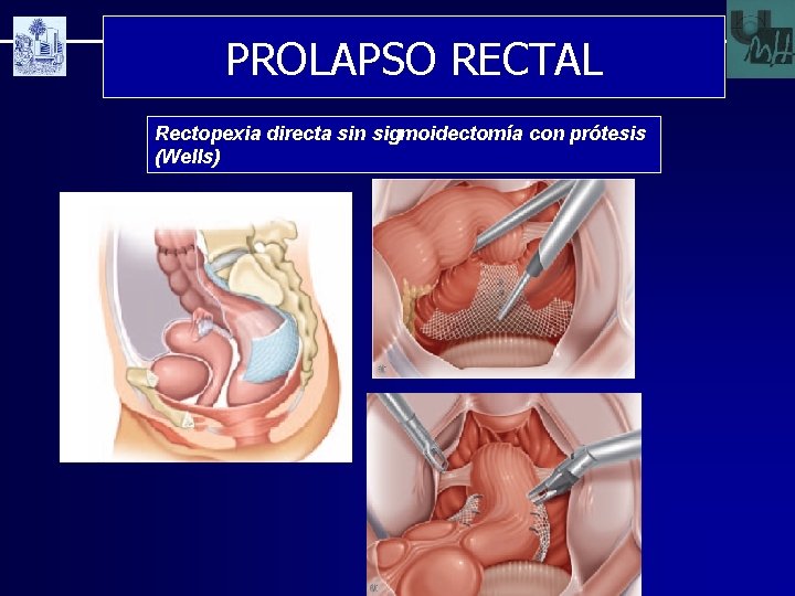 PROLAPSO RECTAL Rectopexia directa sin sigmoidectomía con prótesis (Wells) 