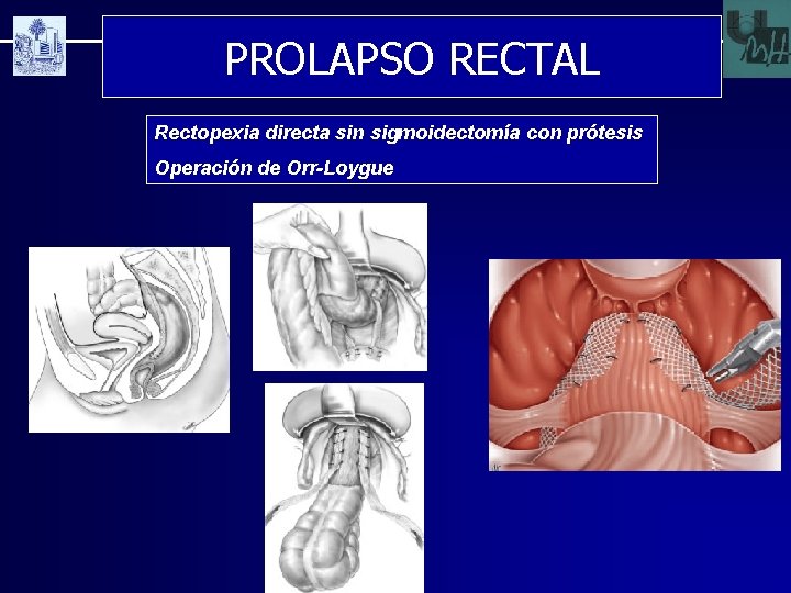 PROLAPSO RECTAL Rectopexia directa sin sigmoidectomía con prótesis Operación de Orr-Loygue 