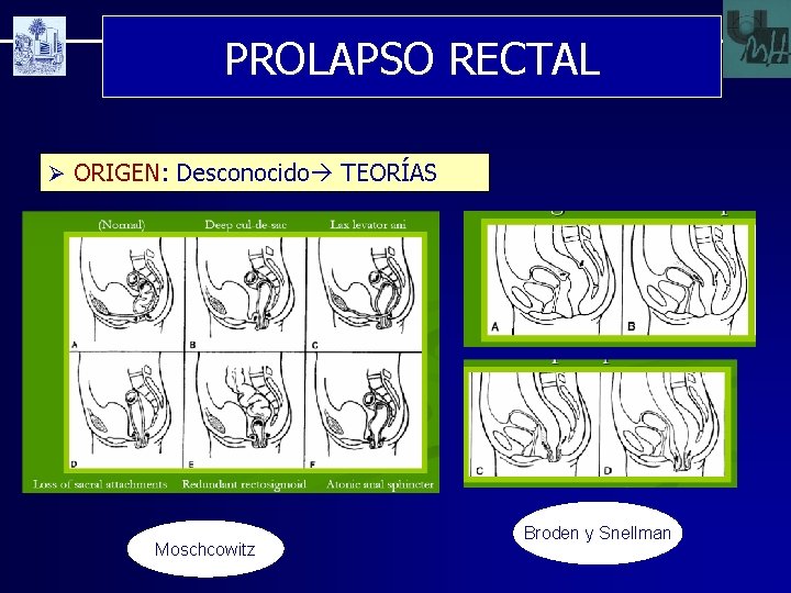 PROLAPSO RECTAL Ø ORIGEN: Desconocido TEORÍAS Moschcowitz Broden y Snellman 