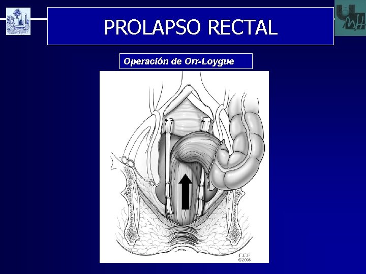 PROLAPSO RECTAL Operación de Orr-Loygue 