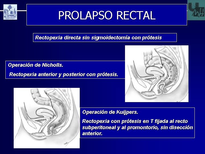 PROLAPSO RECTAL Rectopexia directa sin sigmoidectomía con prótesis Operación de Nicholls. Rectopexia anterior y