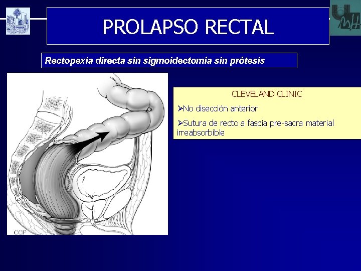 PROLAPSO RECTAL Rectopexia directa sin sigmoidectomía sin prótesis CLEVELAND CLINIC ØNo disección anterior ØSutura