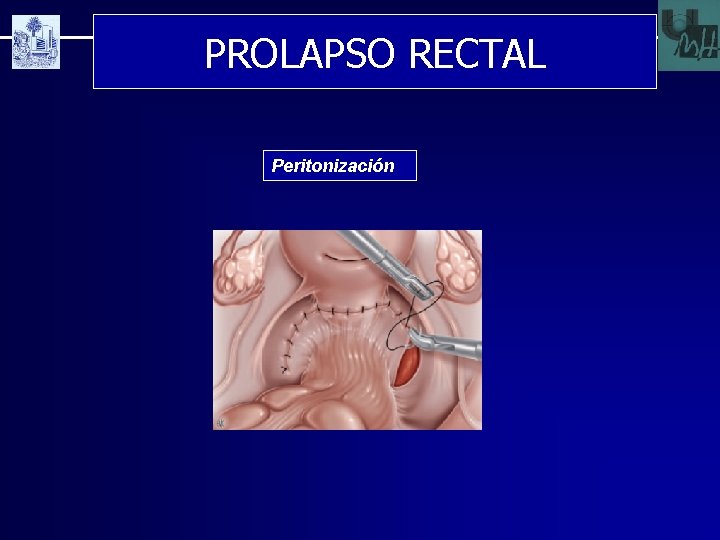 PROLAPSO RECTAL Peritonización 