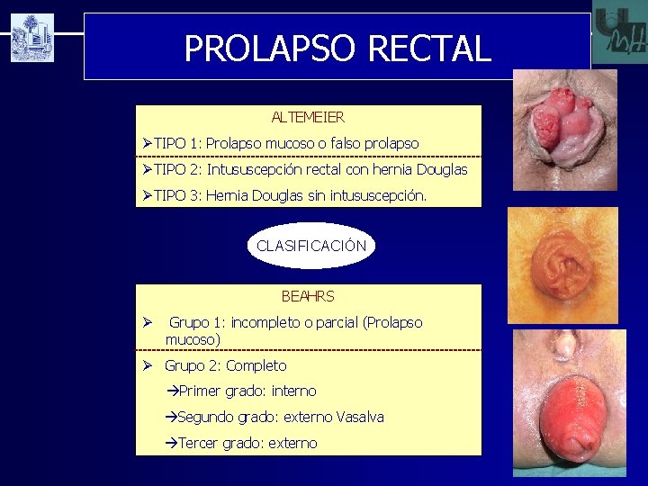 PROLAPSO RECTAL ALTEMEIER ØTIPO 1: Prolapso mucoso o falso prolapso ØTIPO 2: Intususcepción rectal