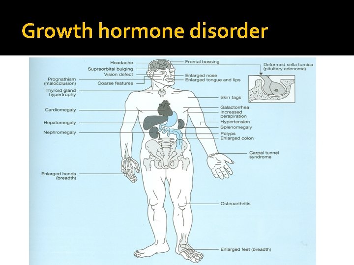 Growth hormone disorder 