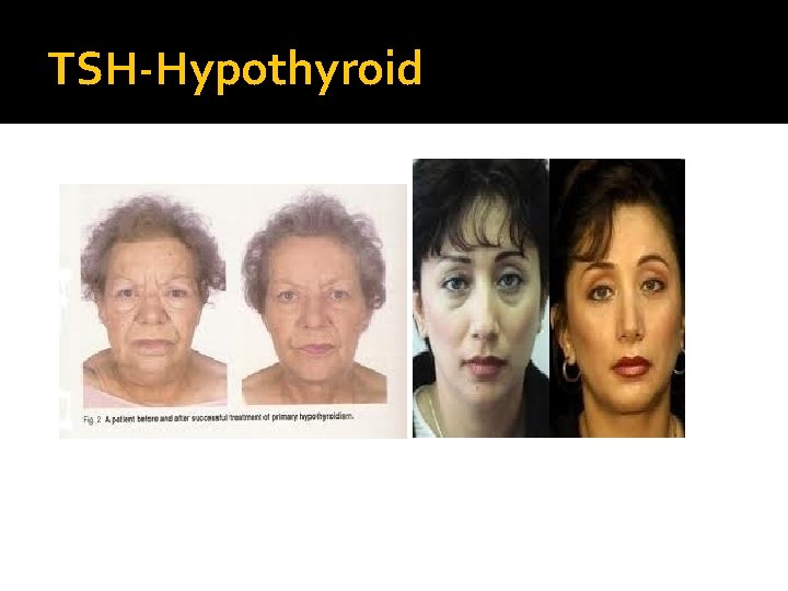 TSH-Hypothyroid 