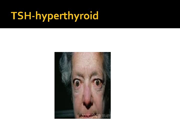 TSH-hyperthyroid 