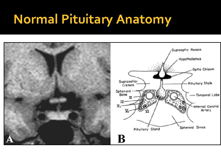 Normal Pituitary Anatomy Modified from Lechan RM. Neuroendocrinology of Pituitary Hormone Regulation. Endocrinology and