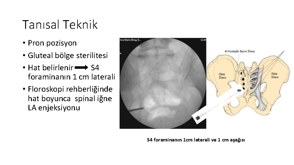 Tanısal Teknik • Pron pozisyon • Gluteal bölge sterilitesi • Hat belirlenir S 4