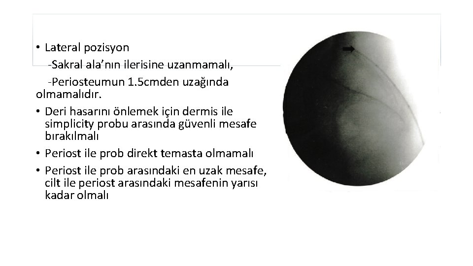  • Lateral pozisyon -Sakral ala’nın ilerisine uzanmamalı, -Periosteumun 1. 5 cmden uzağında olmamalıdır.