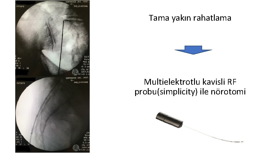 Tama yakın rahatlama Multielektrotlu kavisli RF probu(simplicity) ile nörotomi 