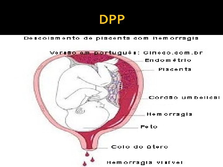 DPP 
