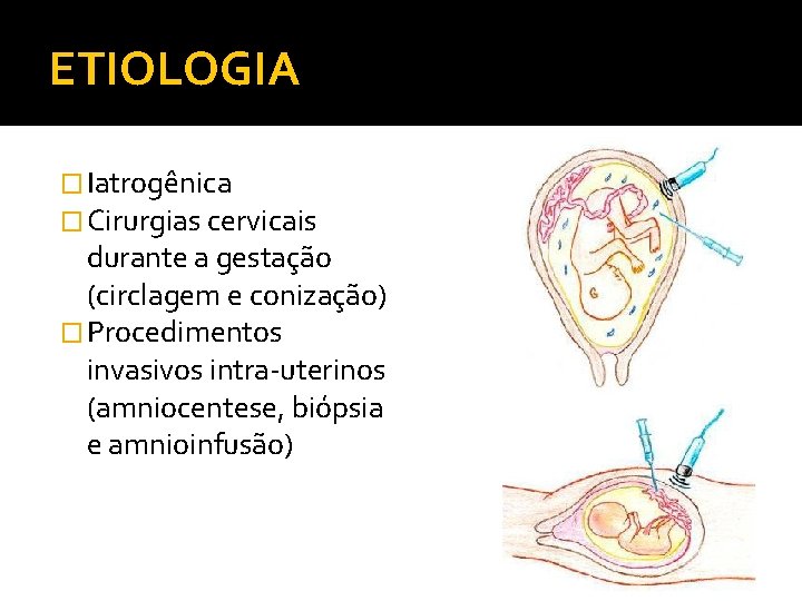 ETIOLOGIA � Iatrogênica � Cirurgias cervicais durante a gestação (circlagem e conização) � Procedimentos