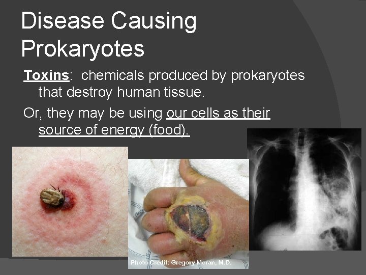 Disease Causing Prokaryotes Toxins: chemicals produced by prokaryotes that destroy human tissue. Or, they