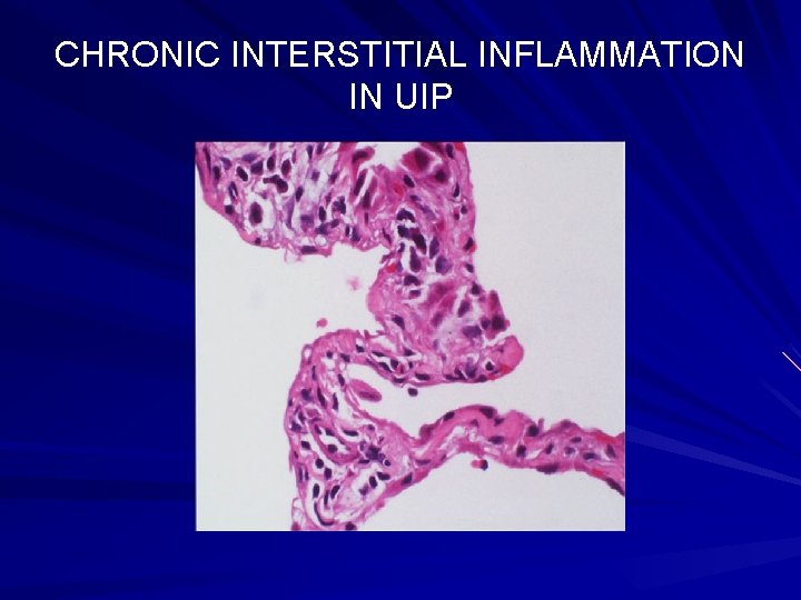 CHRONIC INTERSTITIAL INFLAMMATION IN UIP 