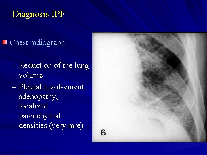 Diagnosis IPF Chest radiograph – Reduction of the lung volume – Pleural involvement, adenopathy,