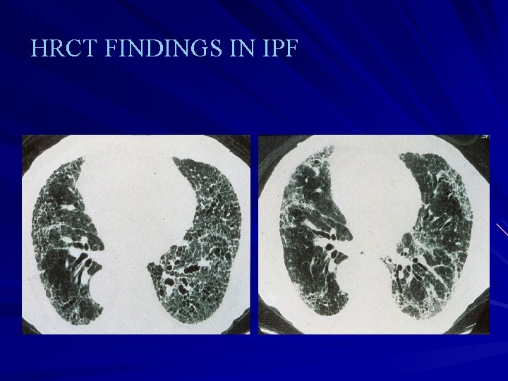 HRCT FINDINGS IN IPF 