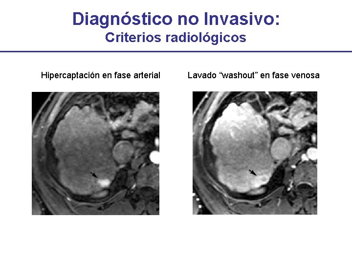Diagnóstico no Invasivo: Criterios radiológicos Hipercaptación en fase arterial Lavado “washout” en fase venosa