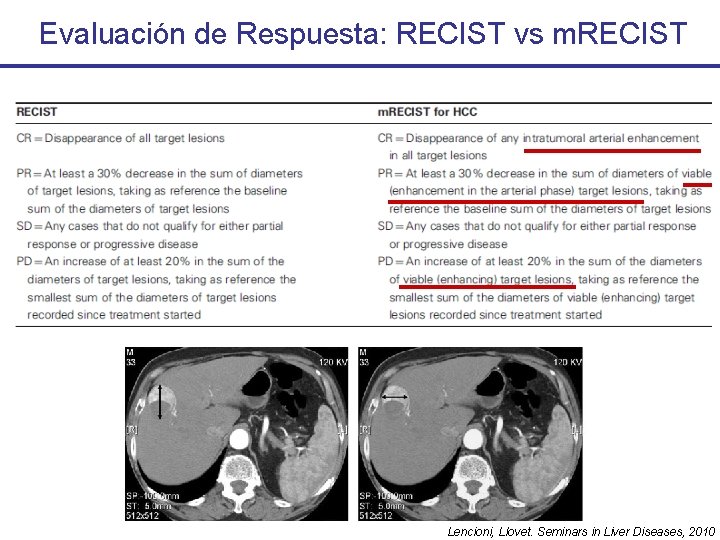 Evaluación de Respuesta: RECIST vs m. RECIST Lencioni, Llovet. Seminars in Liver Diseases, 2010