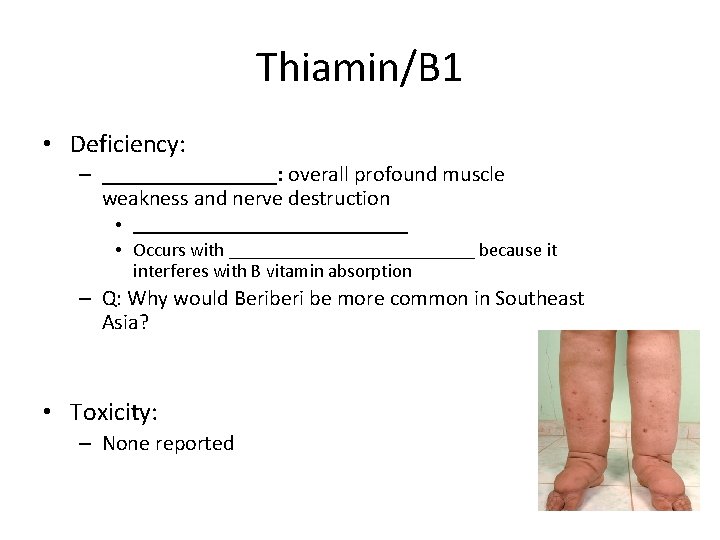 Thiamin/B 1 • Deficiency: – ________: overall profound muscle weakness and nerve destruction •
