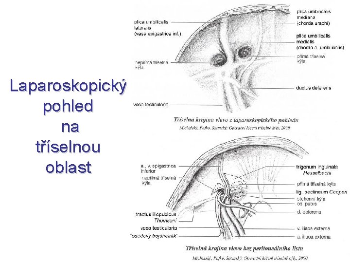 Laparoskopický pohled na tříselnou oblast 