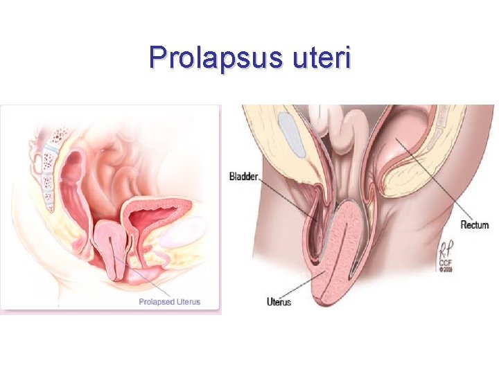 Prolapsus uteri 