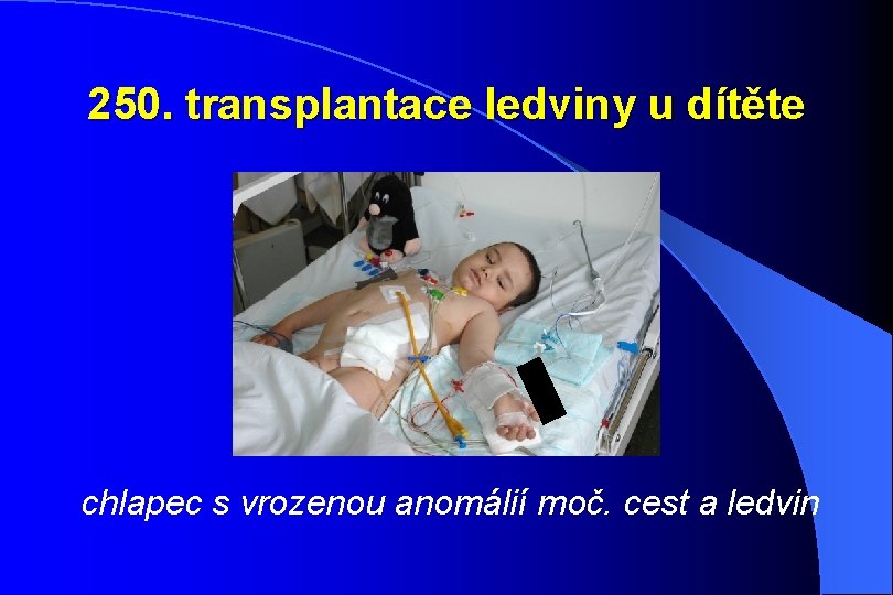 250. transplantace ledviny u dítěte chlapec s vrozenou anomálií moč. cest a ledvin 