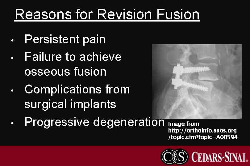 Reasons for Revision Fusion • • Persistent pain Failure to achieve osseous fusion Complications