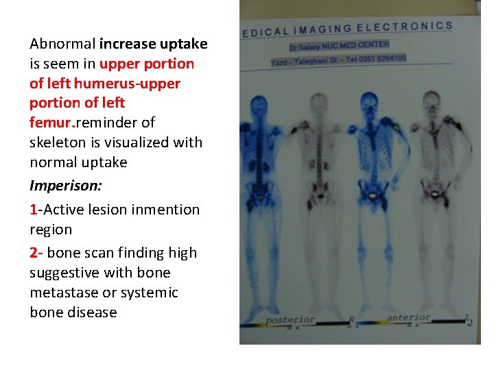 Abnormal increase uptake is seem in upper portion of left humerus-upper portion of left