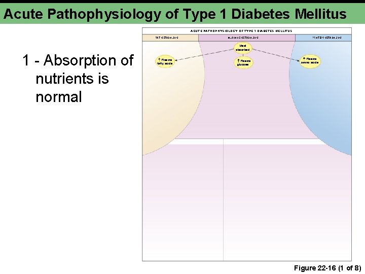 Acute Pathophysiology of Type 1 Diabetes Mellitus ACUTE PATHOPHYSIOLOGY OF TYPE 1 DIABETES MELLITUS