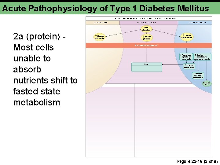 Acute Pathophysiology of Type 1 Diabetes Mellitus ACUTE PATHOPHYSIOLOGY OF TYPE 1 DIABETES MELLITUS