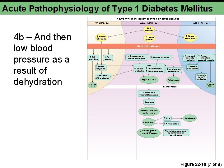 Acute Pathophysiology of Type 1 Diabetes Mellitus ACUTE PATHOPHYSIOLOGY OF TYPE 1 DIABETES MELLITUS