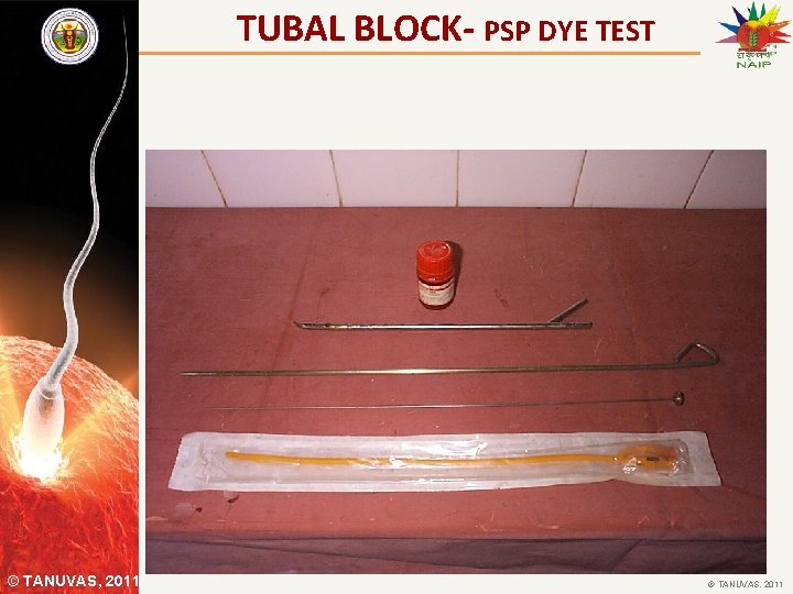 TUBAL BLOCK- PSP DYE TEST © TANUVAS, 2011 