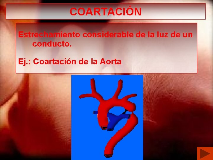 COARTACIÓN Estrechamiento considerable de la luz de un conducto. Ej. : Coartación de la