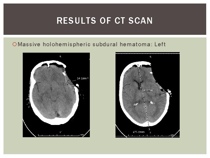 RESULTS OF CT SCAN Massive holohemispheric subdural hematoma: Left 