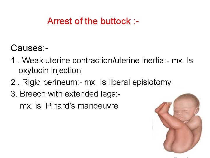 Arrest of the buttock : Causes: 1. Weak uterine contraction/uterine inertia: - mx. Is