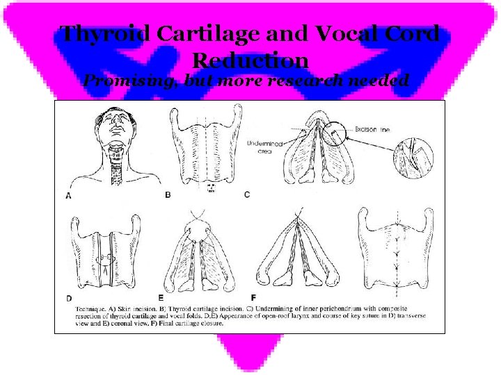 Thyroid Cartilage and Vocal Cord Reduction Promising, but more research needed 