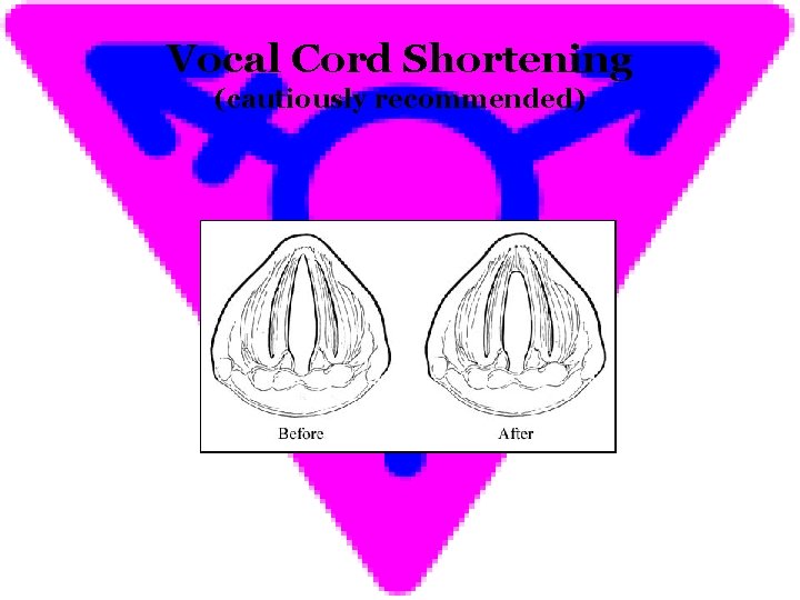 Vocal Cord Shortening (cautiously recommended) 